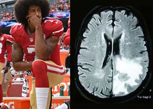 NFL protests = brain damage